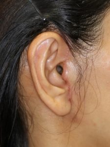 新宿ラクル美容外科クリニック　山本厚志　ナチュラルフェイスリフト　耳の傷痕　手術後１週間目　６月２８日