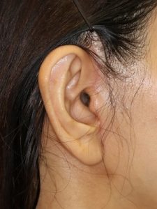 新宿ラクル美容外科クリニック　山本厚志　ナチュラルフェイスリフト　耳の傷痕　手術後１ヶ月目　６月２８日