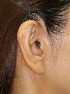新宿ラクル美容外科クリニック　山本厚志　ナチュラルフェイスリフト　耳の傷痕　手術後６ヶ月目　３月１７日