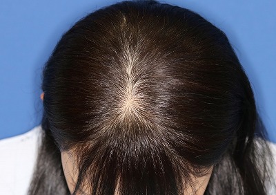 ビフォーアフター 薄毛治療 Dr Cyj ヘアーフィラー 50代女性 4回目の手術後2週間目の変化です 新宿ラクル美容外科クリニック 山本厚志のブログ