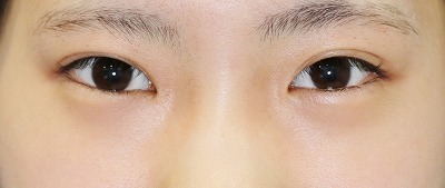 目元整形のビフォーアフター 10代女性 眉下切開法 下眼瞼下制術 埋没法 たれ目術 手術後1ヶ月目の変化をご紹介します 新宿ラクル美容外科クリニック 山本厚志のブログ