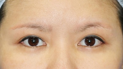 目元整形のビフォーアフター 40代女性 眉下切開法 手術後2ヶ月目の変化をご紹介します 新宿ラクル美容外科クリニック 山本厚志のブログ