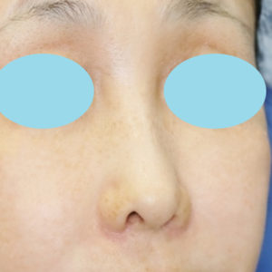 新宿ラクル美容外科クリニック　山本厚志　「小鼻縮小+α法」　手術後１ヶ月目　11月17日