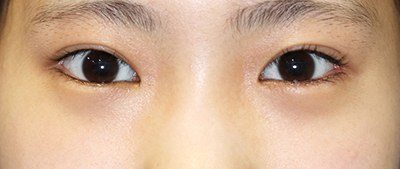 目元整形のビフォーアフター 10代女性 眉下切開法 下眼瞼下制術 埋没法 たれ目術 手術後1ヶ月目の変化をご紹介します 新宿ラクル美容外科クリニック 山本厚志のブログ