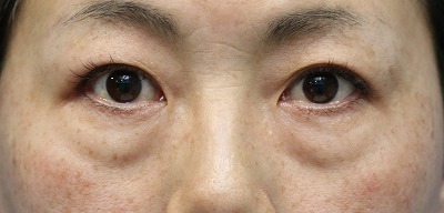 目元の膨らみ 改善ビフォーアフター 40代女性 切らない目の下のたるみ取り ヒアルロン酸 Tear Trough の変化をご紹介します 新宿ラクル美容外科クリニック 山本厚志のブログ