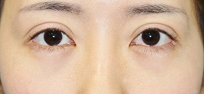 二重整形のビフォーアフター 30代女性 全切開法二重術 眼瞼下垂の変化をご紹介します 新宿ラクル美容外科クリニック 山本厚志のブログ