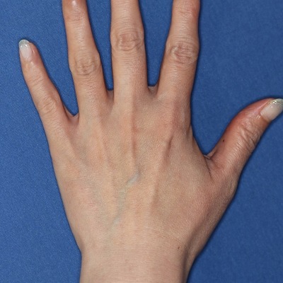 手の甲や指のシワ改善のビフォーアフター 40代女性 プレミアムprp Fgf皮膚再生療法 の経過をご紹介 新宿ラクル美容外科クリニック 山本厚志のブログ