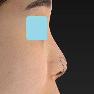 「耳介軟骨移植＋鼻尖縮小（close法）」　新宿ラクル美容外科クリニック　２０代女性　デザイン　５月２７日