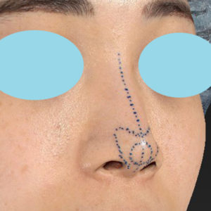「耳介軟骨移植＋鼻尖縮小（close法）」　新宿ラクル美容外科クリニック　２０代女性　デザイン　５月２７日