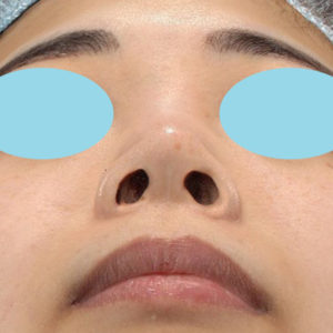 「耳介軟骨移植＋鼻尖縮小（close法）」　新宿ラクル美容外科クリニック　２０代女性　手術後１ヶ月目　７月２日