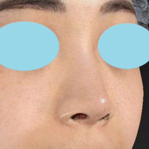 「耳介軟骨移植＋鼻尖縮小（close法）」　新宿ラクル美容外科クリニック　２０代女性　手術後２ヶ月目　７月１７日