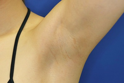 豊胸バッグ Motiva 施術のワキの傷の経過 新宿ラクル美容外科クリニック 山本厚志のブログ