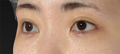 新宿ラクル美容外科クリニック　山本厚志　下眼瞼下制術（グラマラスライン形成術（皮膚切開法））+目尻切開　手術後１ヶ月目　９月２９日