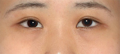 たれ目 目を大きく改善するビフォーアフター 新宿ラクル美容外科クリニック 山本厚志のブログ
