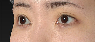 新宿ラクル美容外科クリニック　山本厚志　下眼瞼下制術（グラマラスライン形成術（皮膚切開法））+目尻切開　手術後２ヶ月目　１１月２８日