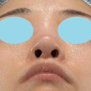 新宿ラクル美容外科クリニック　山本厚志　「小鼻縮小+α法」　手術後１２ヶ月目　６月２日