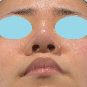 新宿ラクル美容外科クリニック　山本厚志　「鼻プロテーゼ隆鼻術＋鼻尖縮小（close法）」　手術後６ヶ月目　１月３０日