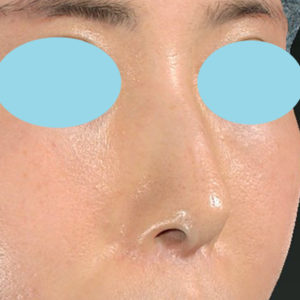 新宿ラクル美容外科クリニック　山本厚志　「小鼻縮小+α法」　手術後１２ヶ月目　６月１日
