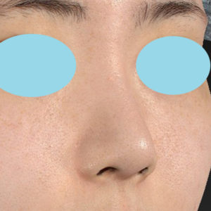 新宿ラクル美容外科クリニック　山本厚志　鼻尖軟骨形成（鼻尖縮小+α法）　手術後２ヶ月目　１月１２日