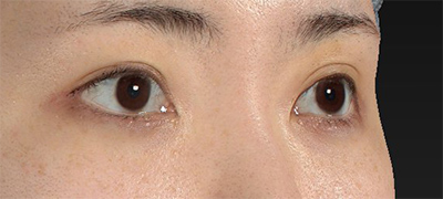 新宿ラクル美容外科クリニック　山本厚志　下眼瞼下制術（グラマラスライン形成術（皮膚切開法））+目尻切開　手術後３ヶ月目　１２月２６日