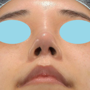 「耳介軟骨移植＋鼻尖縮小（close法）＋ BNLS COCO ６本（鼻根部）」　新宿ラクル美容外科クリニック　山本厚志　２０代女性　手術後３ヶ月目　６月２０日