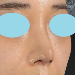 「耳介軟骨移植＋鼻尖縮小（close法）＋ BNLS COCO ６本（鼻根部）」　新宿ラクル美容外科クリニック　山本厚志　２０代女性　手術後１ヶ月目　１１月７日