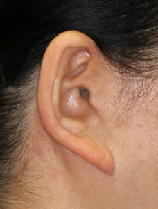 新宿ラクル美容外科クリニック　山本厚志　ナチュラルフェイスネックリフト　耳の傷痕　　手術前　　１１月２４日