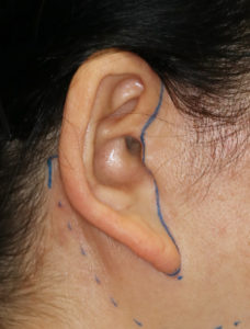 新宿ラクル美容外科クリニック　山本厚志　ナチュラルフェイスネックリフト　耳の傷痕　　デザイン　１１月２４日