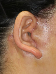新宿ラクル美容外科クリニック　山本厚志　ナチュラルフェイスネックリフト　耳の傷痕　　手術後１週間目　１１月２４日