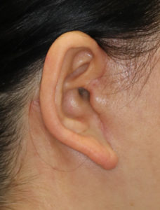 新宿ラクル美容外科クリニック　山本厚志　ナチュラルフェイスネックリフト　耳の傷痕　　手術後１ヶ月目　１１月２４日