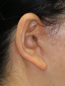 新宿ラクル美容外科クリニック　山本厚志　ナチュラルフェイスネックリフト　耳の傷痕　　手術後３ヶ月目　　１１月２４日