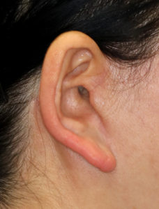 新宿ラクル美容外科クリニック　山本厚志　ナチュラルフェイスネックリフト　耳の傷痕　　手術後６ヶ月目　２月９日