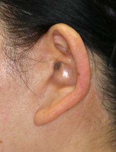 新宿ラクル美容外科クリニック　山本厚志　ナチュラルフェイスネックリフト　耳の傷痕　　手術前　　１１月２４日