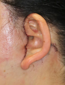 新宿ラクル美容外科クリニック　山本厚志　ナチュラルフェイスネックリフト　耳の傷痕　　手術直後　１１月２４日