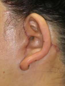 新宿ラクル美容外科クリニック　山本厚志　ナチュラルフェイスネックリフト　耳の傷痕　　手術後１週間目　１１月２４日