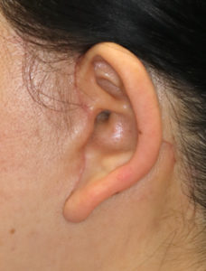 新宿ラクル美容外科クリニック　山本厚志　ナチュラルフェイスネックリフト　耳の傷痕　　手術後１ヶ月目　１１月２４日