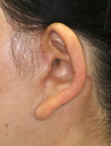 新宿ラクル美容外科クリニック　山本厚志　ナチュラルフェイスネックリフト　耳の傷痕　　手術後２ヶ月目　１１月２４日