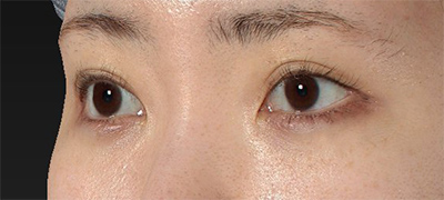 新宿ラクル美容外科クリニック　山本厚志　下眼瞼下制術（グラマラスライン形成術（皮膚切開法））+目尻切開　手術後６ヶ月目　４月１６日