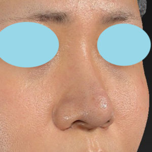 新宿ラクル美容外科クリニック　山本厚志　「鼻プロテーゼ隆鼻術＋鼻尖縮小（close法）」　手術後１２ヶ月目　７月３０日