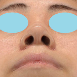 新宿ラクル美容外科クリニック　山本厚志　「小鼻縮小+α法」　手術後１ヶ月目　４月１日