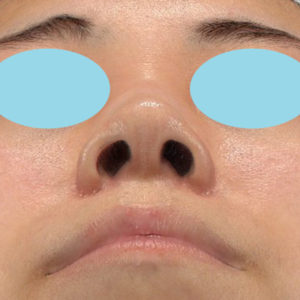 新宿ラクル美容外科クリニック　山本厚志　「小鼻縮小+α法」　手術後２ヶ月目　４月１日