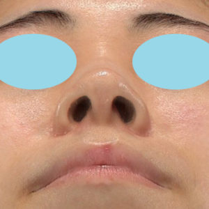 新宿ラクル美容外科クリニック　山本厚志　「小鼻縮小+α法」　手術後３ヶ月目　４月１日