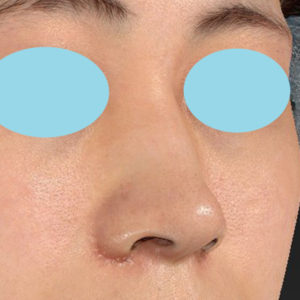 新宿ラクル美容外科クリニック　山本厚志　「小鼻縮小+α法」　手術後１ヶ月目　４月１日