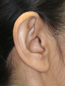 新宿ラクル美容外科クリニック　山本厚志　ナチュラルフェイスリフト　耳の傷痕　手術前　３月３１日