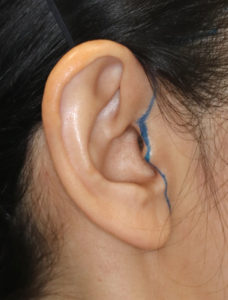 新宿ラクル美容外科クリニック　山本厚志　ナチュラルフェイスリフト　耳の傷痕　デザイン　３月３１日