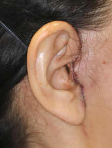 新宿ラクル美容外科クリニック　山本厚志　ナチュラルフェイスリフト　耳の傷痕　手術直後　３月３１日