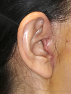 新宿ラクル美容外科クリニック　山本厚志　ナチュラルフェイスリフト　耳の傷痕　手術後１週間目　３月３１日