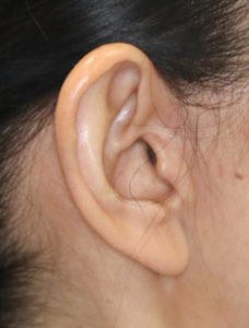 新宿ラクル美容外科クリニック　山本厚志　ナチュラルフェイスリフト　耳の傷痕　手術後１２ヶ月目　３月３１日