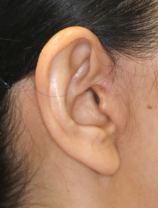 新宿ラクル美容外科クリニック　山本厚志　ナチュラルフェイスリフト　耳の傷痕　手術後３ヶ月目　３月３１日