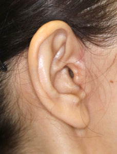 新宿ラクル美容外科クリニック　山本厚志　ナチュラルフェイスリフト　耳の傷痕　手術後６ヶ月目　３月３１日